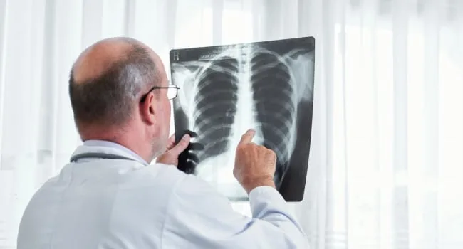 Ստեղծվել է ԱԲ մոդել, որը ճշգրիտ կերպով բացահայտում է թոքերի քաղցկեղը վաղ փուլում